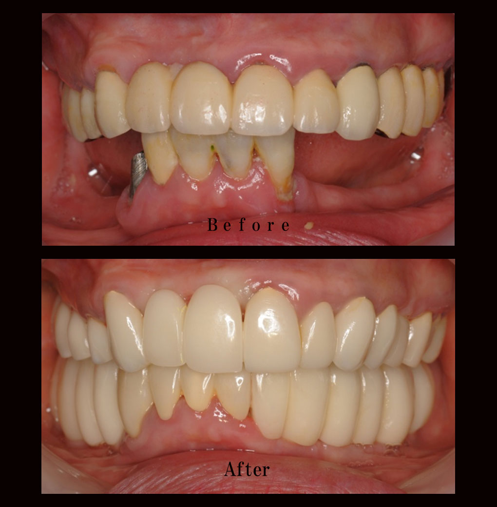多数歯欠損ケース6の正面比較の写真