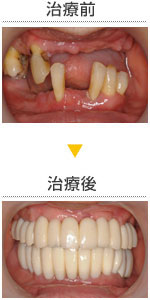 多数歯欠損ケースの画像