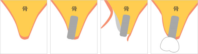 GBR（骨誘導再生法）の図