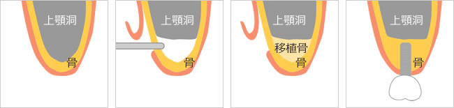 サイナスリフトの図