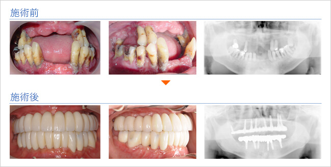 ケース2：多数歯欠損の症例写真