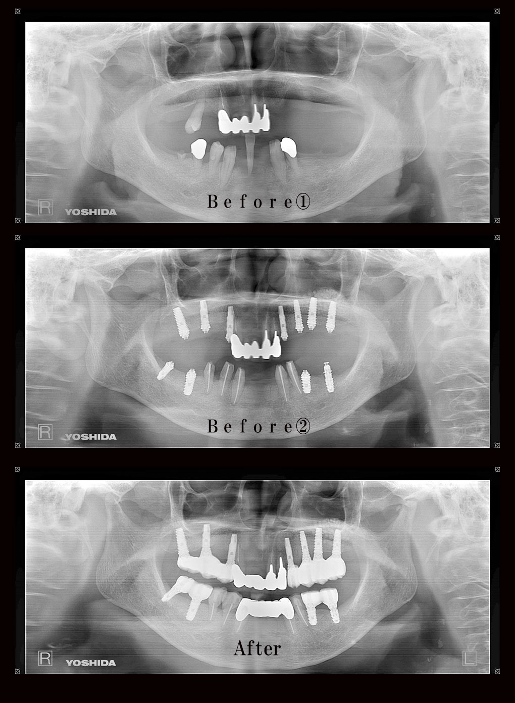 多数歯欠損ケース11のレントゲン比較の写真
