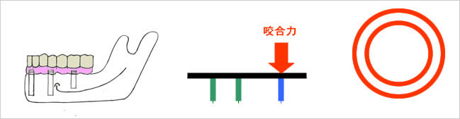 2～3カ月後に最後方のインプラントにも負荷をかける図