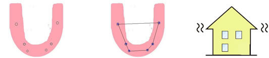 6本のインプラント頚部を結んだ多角形は広い面積を有し、咬合歯負担は物理学的に安定しているの図