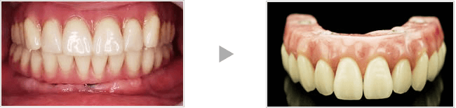 従来の総入れ歯型即時負荷（オールオン4）の写真