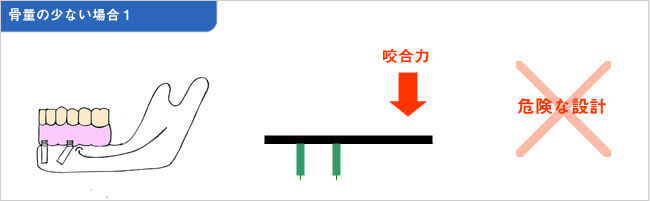 東洋人のように骨量が少ない場合の図