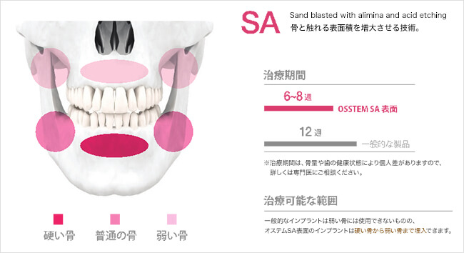 オステムの治療期間と治療可能な範囲の画像