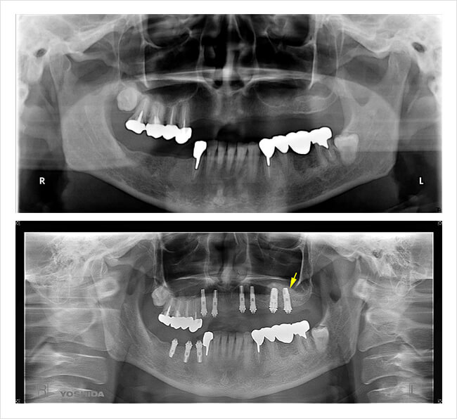 オステムインプラントの治療症例1レントゲン画像