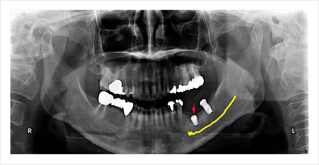 オステムインプラントの治療症例2レントゲン画像