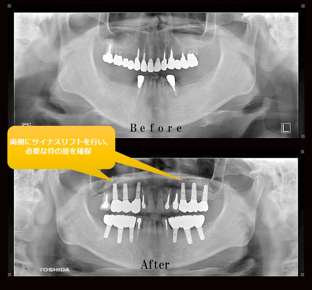 多数歯欠損ケース1のレントゲン比較の写真