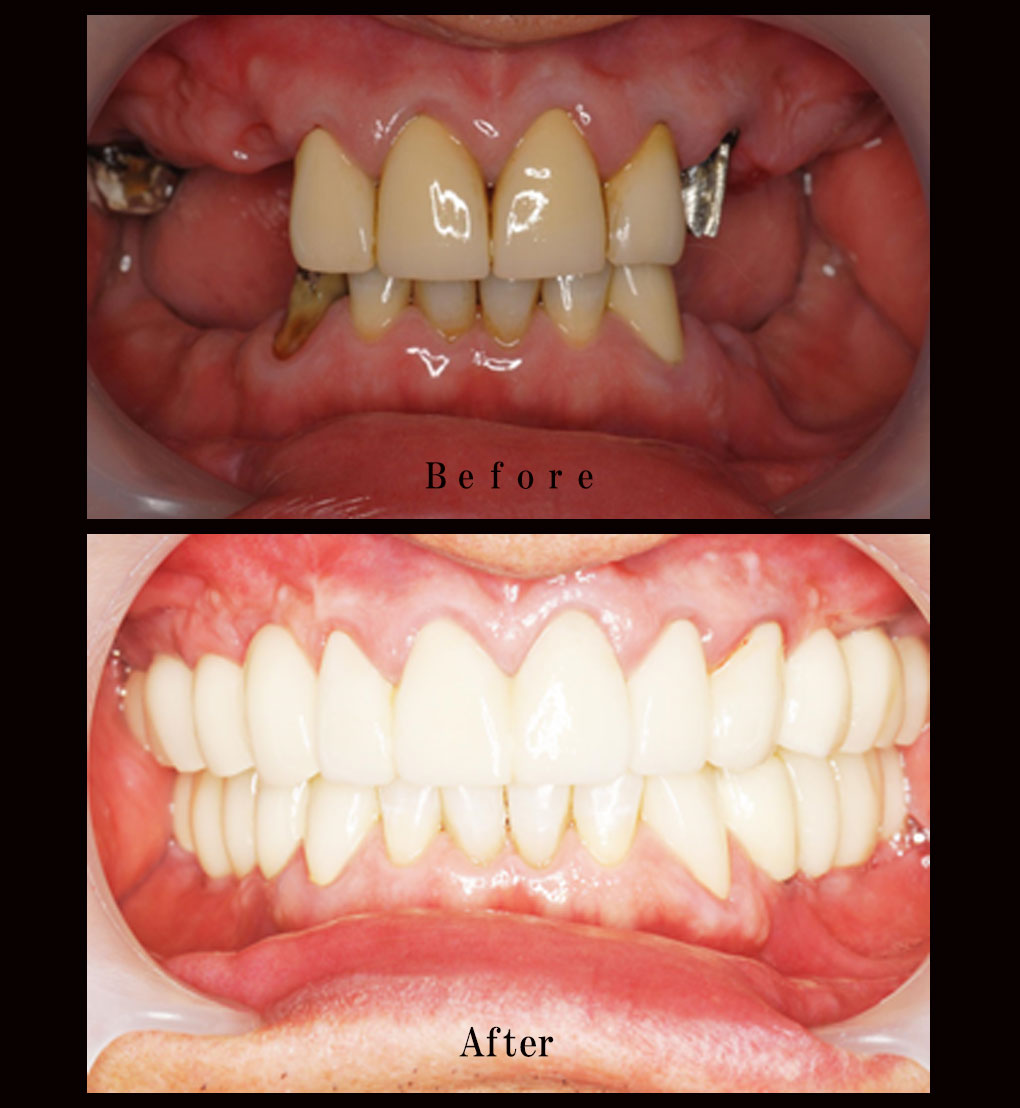 多数歯欠損ケース1の正面比較の写真