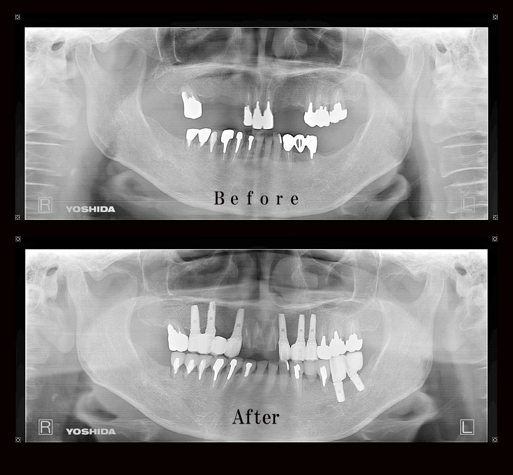 多数歯欠損ケース3のレントゲン比較の写真