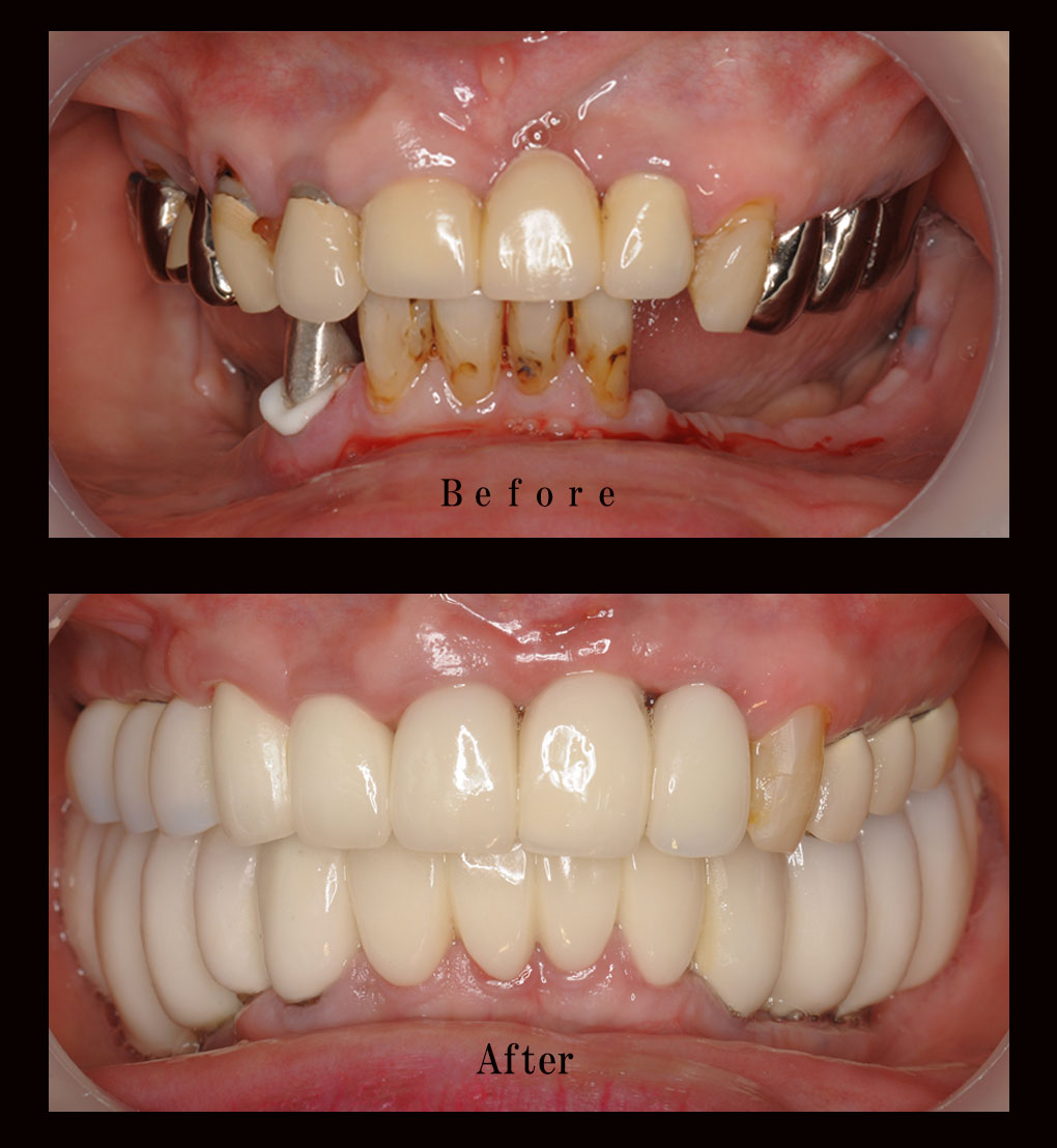 多数歯欠損ケース5の正面比較の写真
