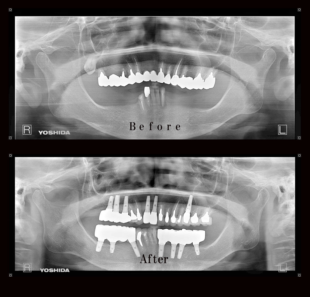 多数歯欠損ケース6のレントゲン比較の写真