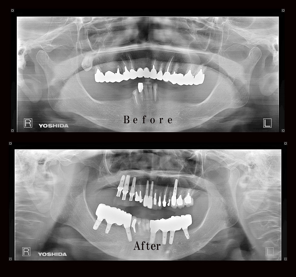 多数歯欠損ケース7のレントゲン比較の写真