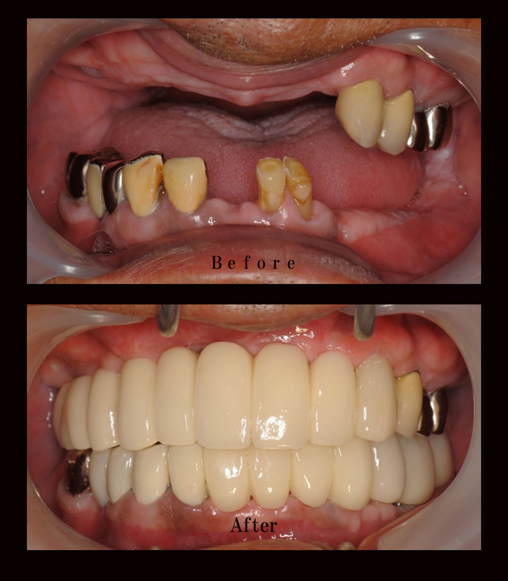 多数歯欠損ケース9の正面比較の写真