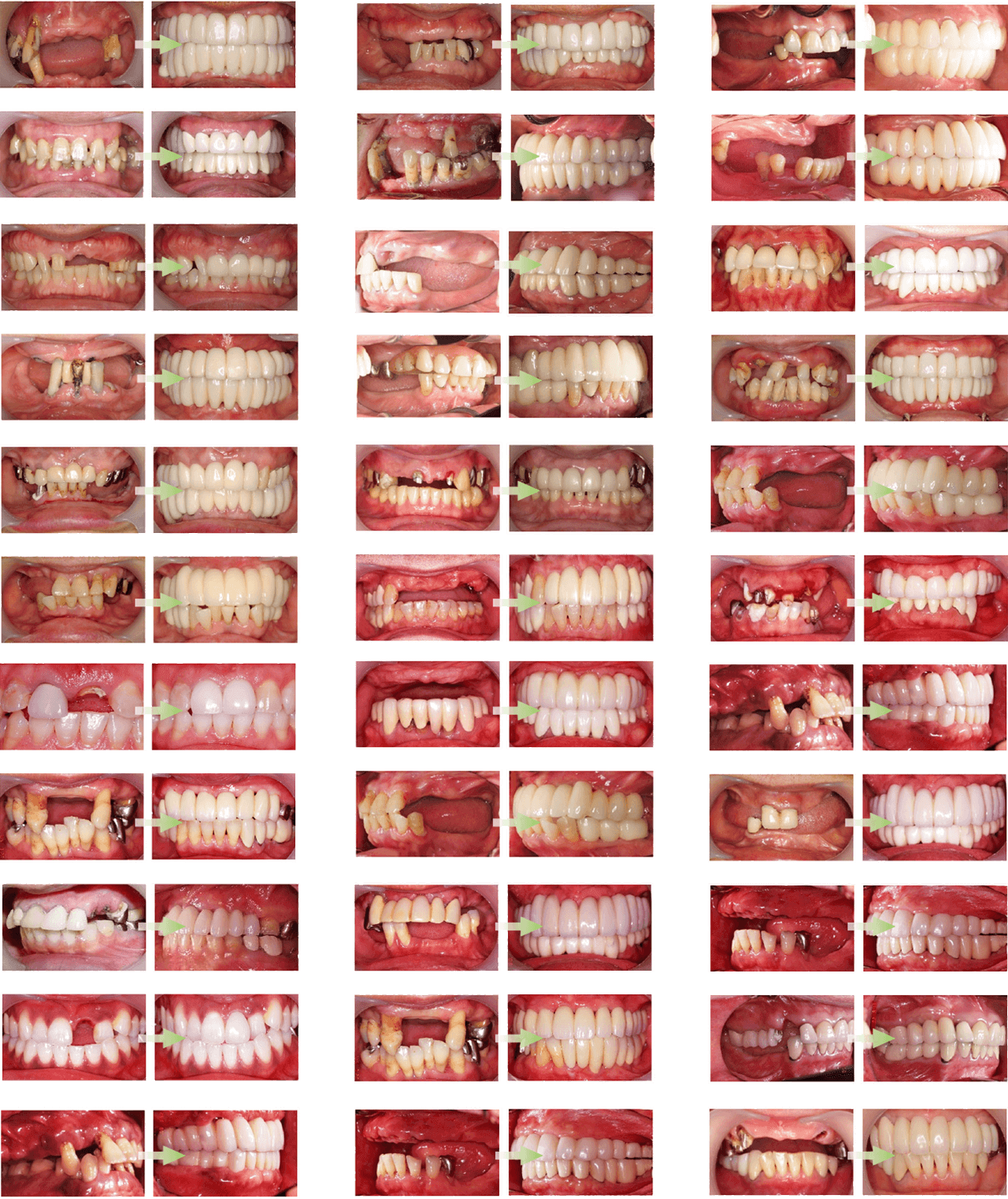 当院の実績 治療症例 朝霧 インプラント 医療法人社団コイケ歯科医院 兵庫県明石市