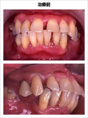 歯周治療の能力の治療前の写真