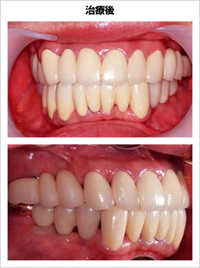 歯周治療の能力の治療後の写真