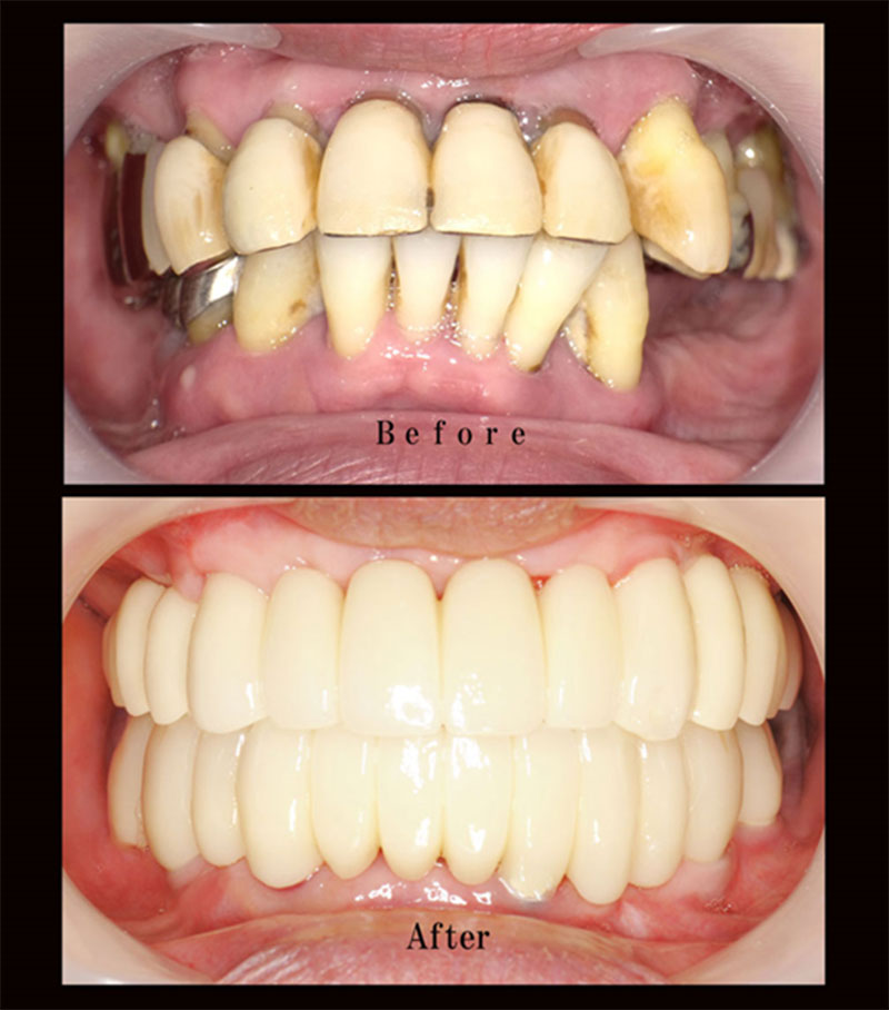 上下フルインプラントの症例写真