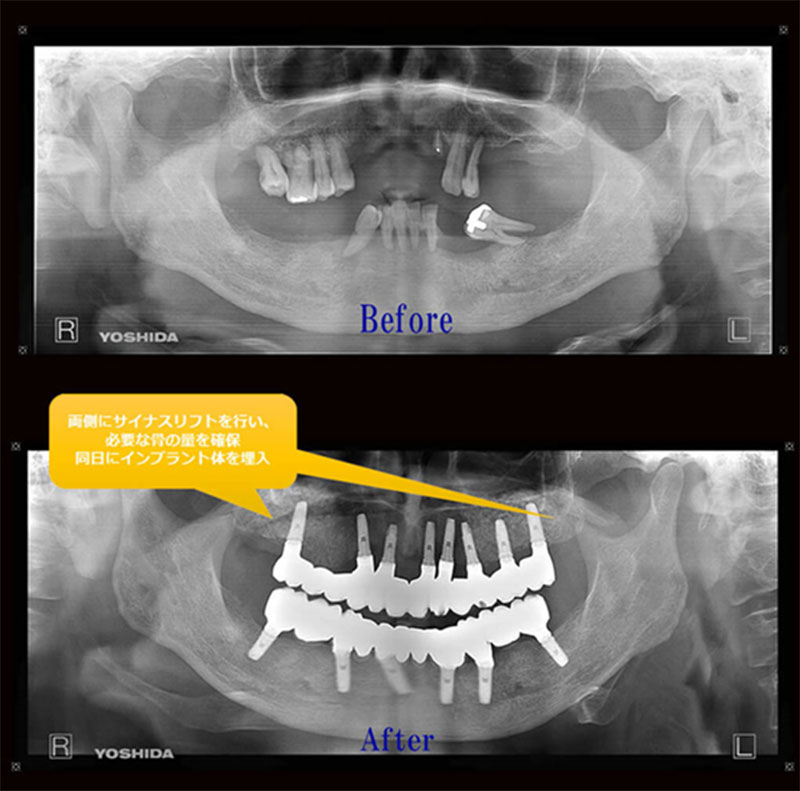 上下フルインプラントの症例レントゲン写真