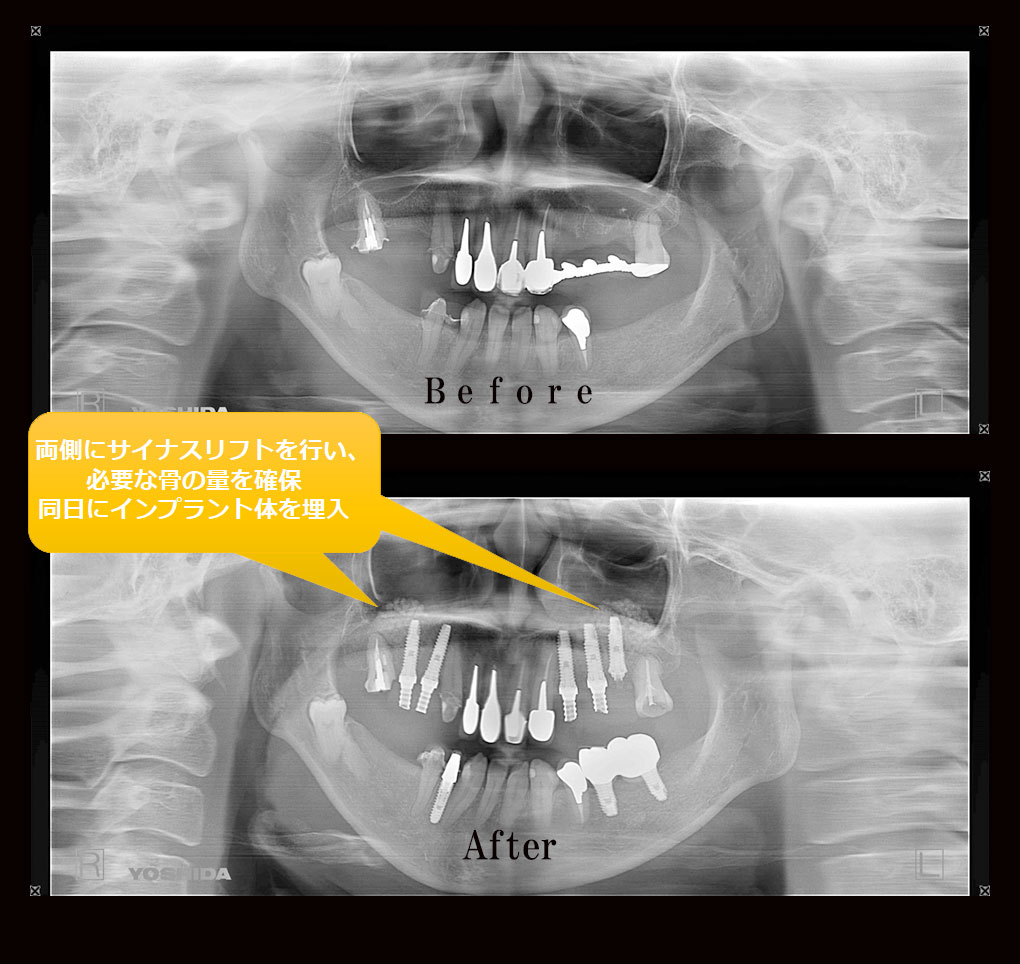 サイナスリフトケース1のレントゲン比較の写真